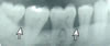 gum disease x-ray